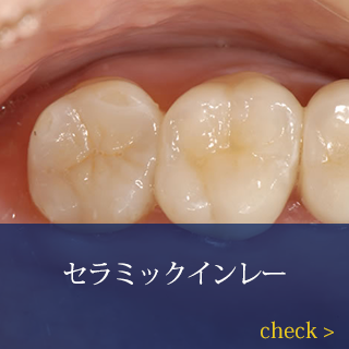 セラミックインレー